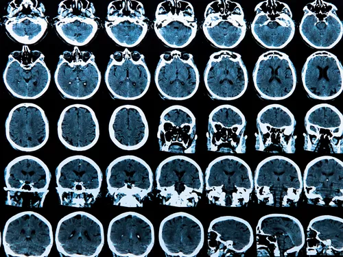 Alzheimer-kór: nem fertőző, de lehet vele fertőzni