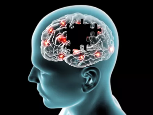A legfontosabb Parkinson-gyógyszerről