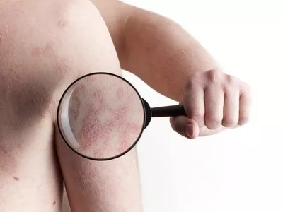 Az allergiás betegségek bőrgyógyászati tünetei és kezelési lehetőségei