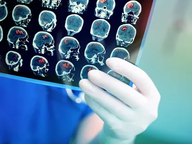 MRI-kontrasztanyagok helyett cukoroldattal is vizsgálhatók az agytumorok