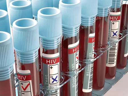 HIV-fertőzöttön segített a rákgyógyszer