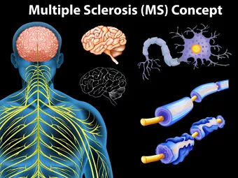 Koleszterin okozza a regenerációs hibát sclerosis multiplexnél