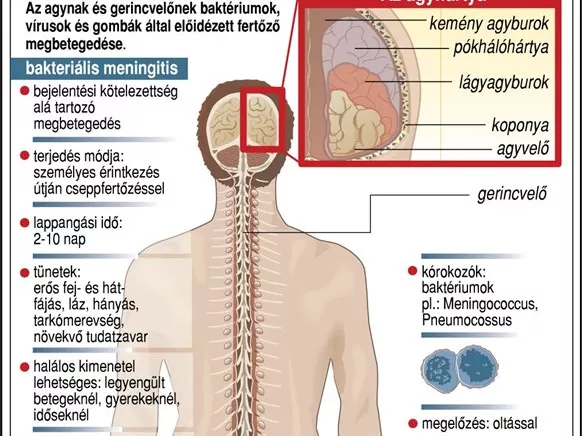 Hatból egy agyhártyagyulladás halállal végződik