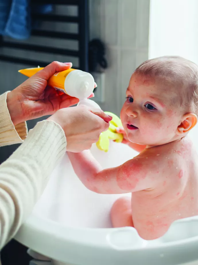 Emelkedő esetszámok: az atópiás dermatitisz a gyógyszertári gyakorlatban