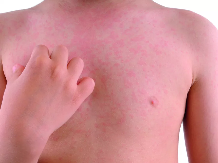 Az urtikáriabetegség diagnosztikája, klasszifikációja és kezelése